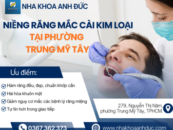 Niềng răng mắc cài kim loại tại phường Trung Mỹ Tây
