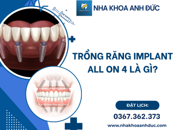 Trồng răng implant All On 4 là gì?